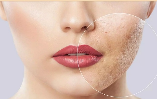 چگونه جای انواع جوش روی پوست را از بین ببریم؟
