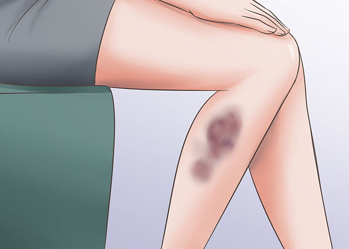 Bruises on the body
