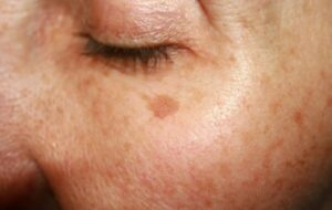 ۷ شیوه موثر برای از بین بردن لک پیری پوست