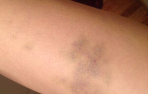 معنی رنگ های مختلف هر یک از کبودی ها چیست و چگونه بهبود می یابند؟