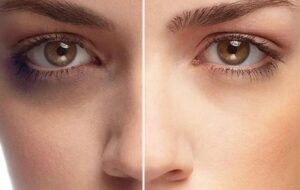 رفع تیرگی زیر چشم تنها با ۹ ترفند خانگی آسان