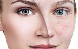 ۱۳روش طبیعی و موثر رفع فوری جای جوش در خانه