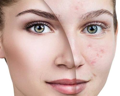 از بین بردن جای جوش