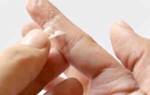 ۵ روش پاک کردن آسان چسب قطره ای از روی پوست