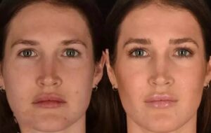 آنچه باید درباره جراحی بوکال فت برای زیبایی و فرم سازی صورت بدانید