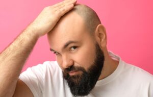 آنچه مردان باید قبل از کاشت مو بدانند ولی به آنها نمی گویند