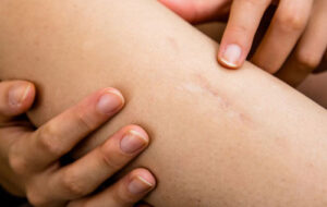 ۱۸ راه حل طبیعی و خانگی برای رفع فوری جای زخم در خانه