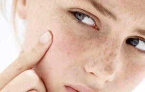 بهترین روش‌های پیشگیری و  راه درمان لک صورت در بارداری