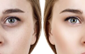 رفع گودی زیر چشم با ۱۵ روش ساده خانگی