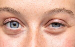 ۷ درمان خانگی طبیعی و موثر برای درمان فوری افتادگی پلک