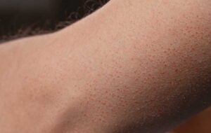 پوست مرغی به چه علت ایجاد می شود؟ + بهترین درمان های خانگی برای آن