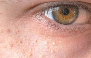 علت میلیای دور چشم و صورت چیست؟ + درمان خانگی آن