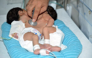 دوقلوهای به هم چسبیده اهوازی در شیراز از یکدیگر جدا شدند+جزئیات