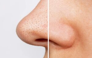 ۱۰ روش خانگی فوق العاده عالی و موثر برای از بین بردن جوش سر سیاه روی بینی