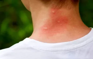 ۱۱ روش موثر برای جلوگیری از نیش حشرات در تابستان