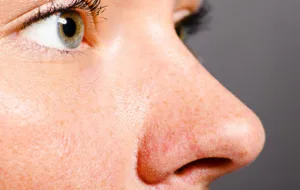 بهترین راه های خانگی برای از بین بردن و پاکسازی منافذ باز پوست بینی