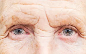 امیدواری جدید به درمان کوری چشم در بین افراد مسن