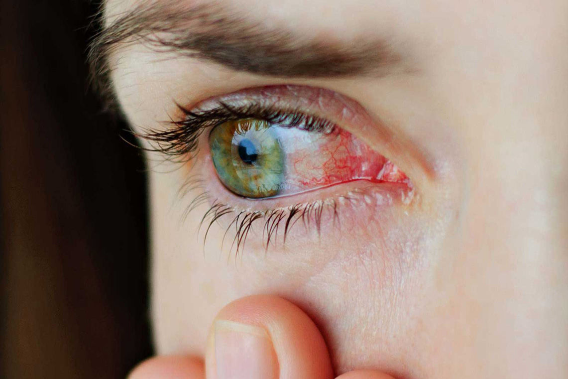 علت قرمز شدن ناگهانی چشم چیست؟ + روش درمان