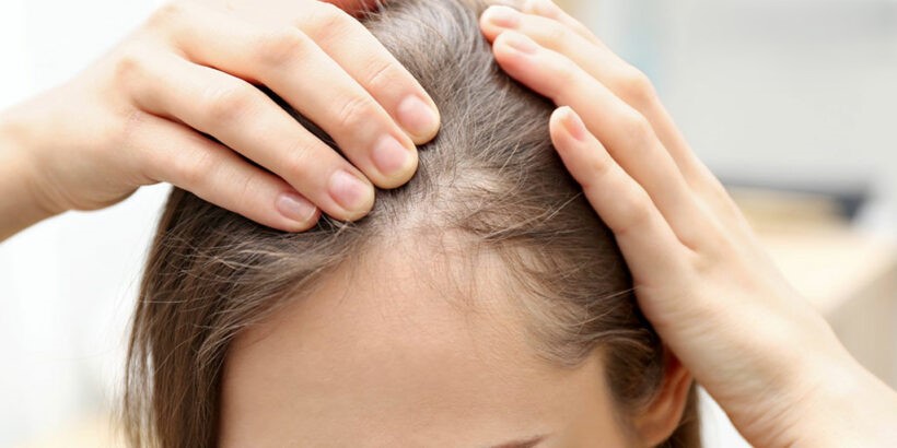 پشت پرده ریزش موی جلوی سر زنان