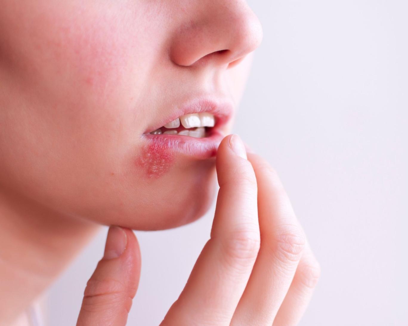 معجزه ویروس تبخال: کاهش یا ناپدیدشدن تومورهای پوستیِ دور از محل تزریق در کارآزمایی بالینی