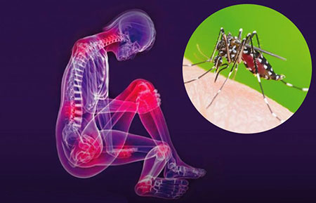 chikungunya