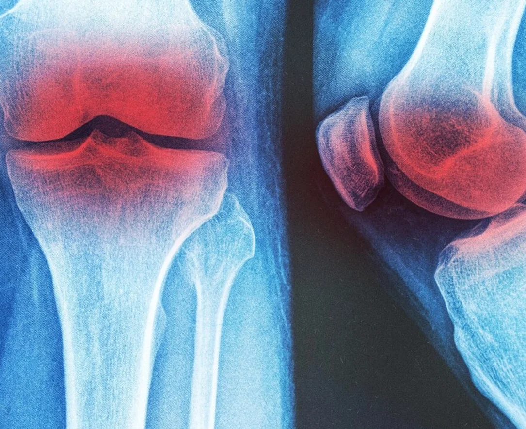 ۳ راهکار غیردارویی مؤثر برای تسکین درد و ورم آرتروز زانو