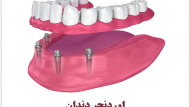 اوردنچر دندان چیست؟