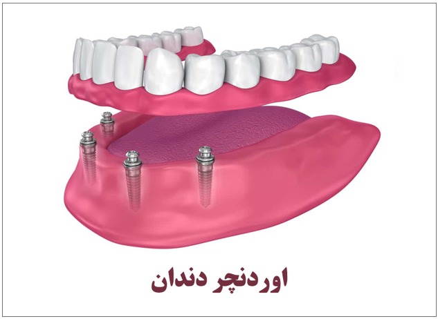 اوردنچر دندان چیست؟