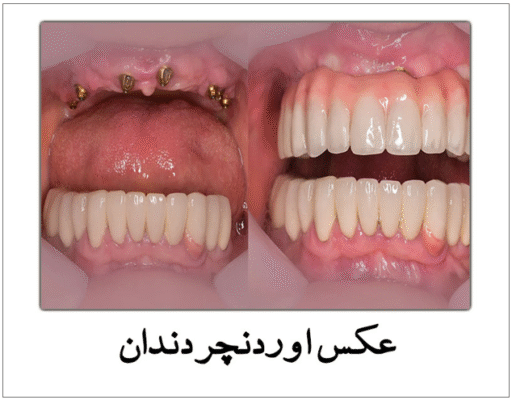  عکس اوردنچر دندان 