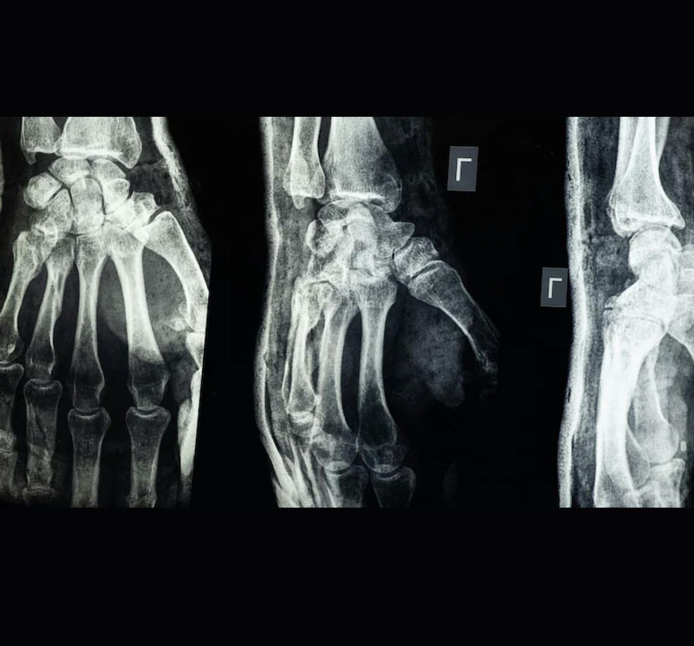 چسب استخوانی چینی، استخوان شکسته را در سه دقیقه ترمیم می‌کند