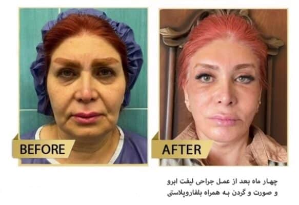 انواع لیفت صورت | بررسی روشهای مختلف لیفت صورت + جدول مقایسه 4 لیفتصورت