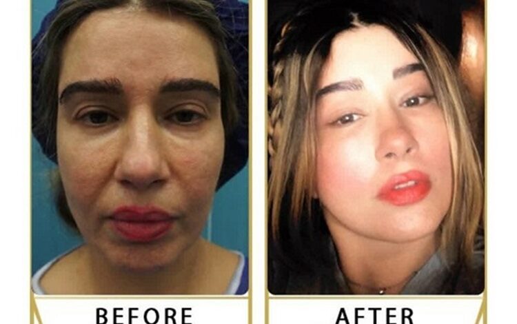 انواع لیفت صورت | بررسی روشهای مختلف لیفت صورت + جدول مقایسه 1 لیفتصورتوگردنوهزینهآن 1