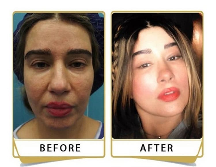 انواع لیفت صورت | بررسی روش‌های مختلف لیفت صورت + جدول مقایسه