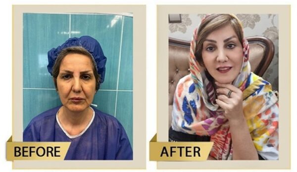 انواع لیفت صورت | بررسی روشهای مختلف لیفت صورت + جدول مقایسه 3 نمونهلیفتصورت