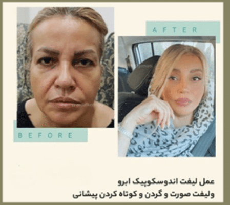 انواع لیفت صورت | بررسی روشهای مختلف لیفت صورت + جدول مقایسه 5 پایگاه خبری اول فارس avalfars.ir