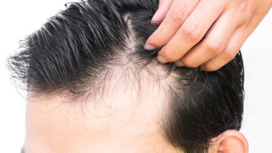 توضیح متخصص پوست درباره دلایل شایع ریزش مو