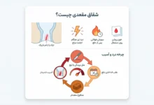 شقاق مقعدی چیست و چرا در مرکز تهران باید زود درمان شود؟ مسیر تشخیص تا درمان در مطب دکتر قمری