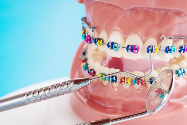 ۰ تا ۱۰۰ مراحل ارتودنسی دندان ها را بدانید
