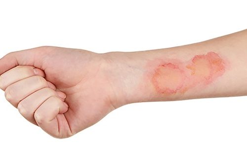 چند روش درمان سریع  وخانگی سوختگی پوست در اثر روغن داغ