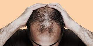 کشف یک عامل جدید که ریزش مو در مردان را تشدید می کند