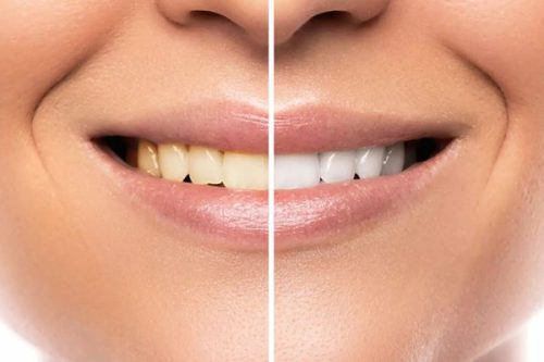 سفید کردن دندان  ۵ روش پزشکی و ۱۰ روش خانگی سفیدی دندان