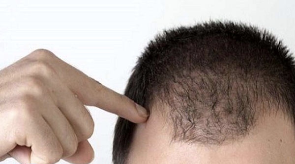 جلوگیری از ریزش مو با رعایت چند نکته که لازم است بدانید