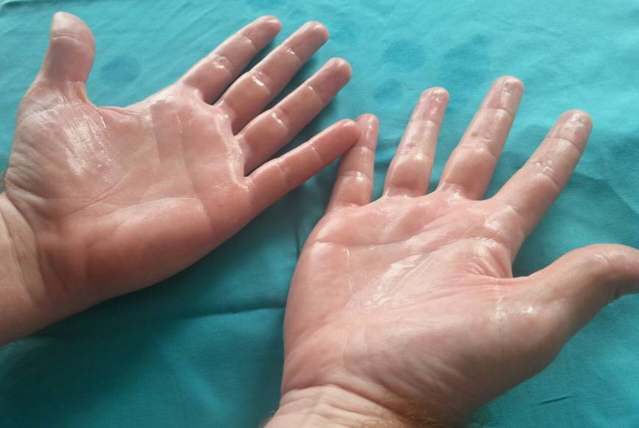 درمان های خانگی موثر برای مقابله با تعریق کف دست