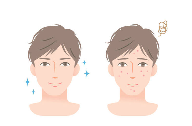 چند روش برای جلوگیری از جوش زدن صورت و درمان آن