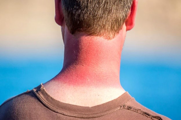درمان سریع آفتاب سوختگی با چند راه حل آسان و موثر