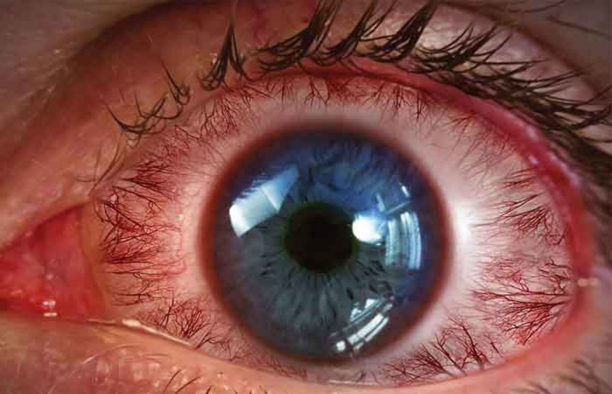 چند روش ساده برای درمان خشکی چشم + شایع‌ترین علل خشکی چشم