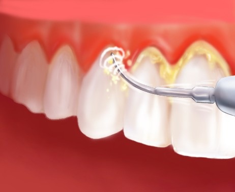 ۱۳ راهکار از بین بردن جرم دندان در خانه