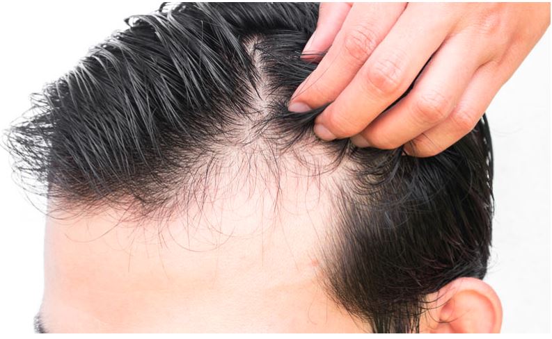 ۶ دلیل رایج‌ ریزش مو که نباید دست کم بگیرید