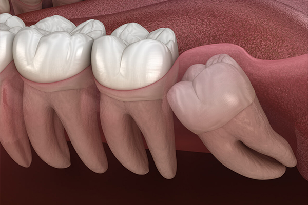 نکات بسیار مهمی که باید بعد از کشیدن دندان  عقل بدانید