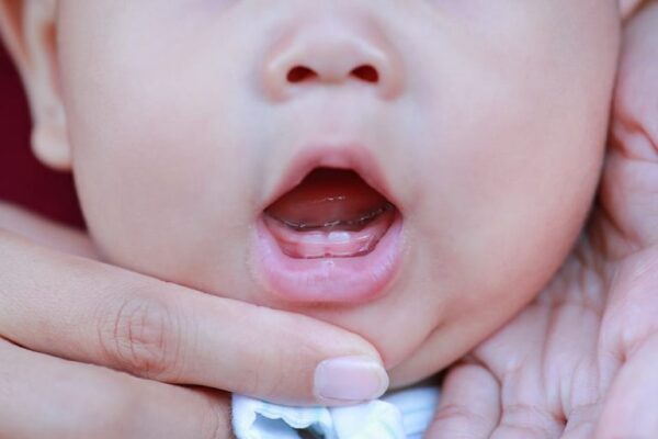 آنچه باید درباره دندان درآوردن نوزاد،علائم، مراحل و راهکارهای آن بدانید